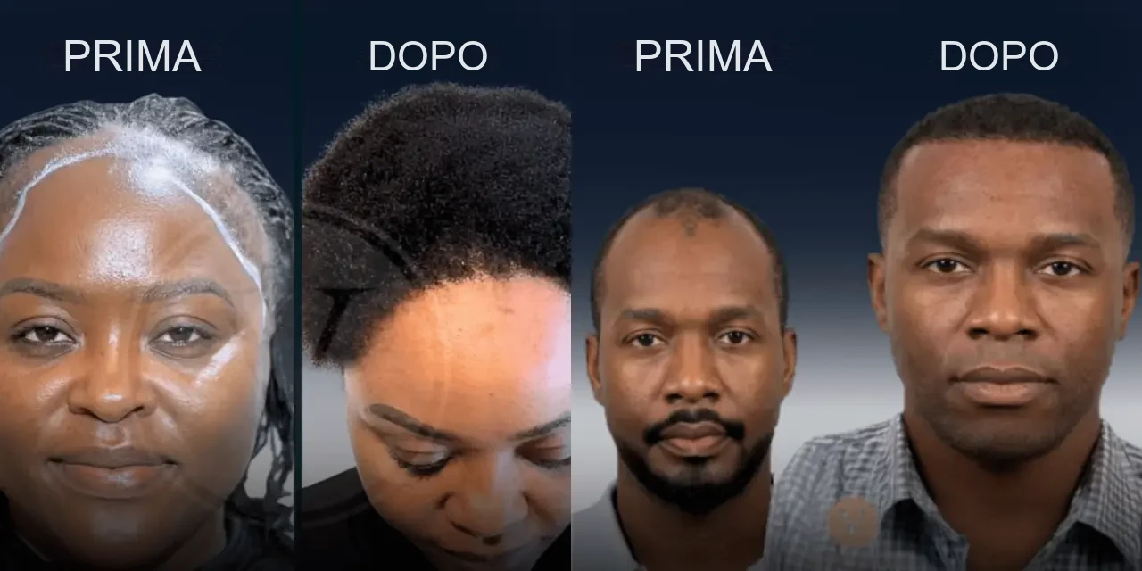 Istanbul Vita: risultati prima e dopo del trapianto di capelli afro