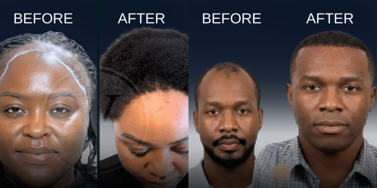 Afro Hair Transplant Before After