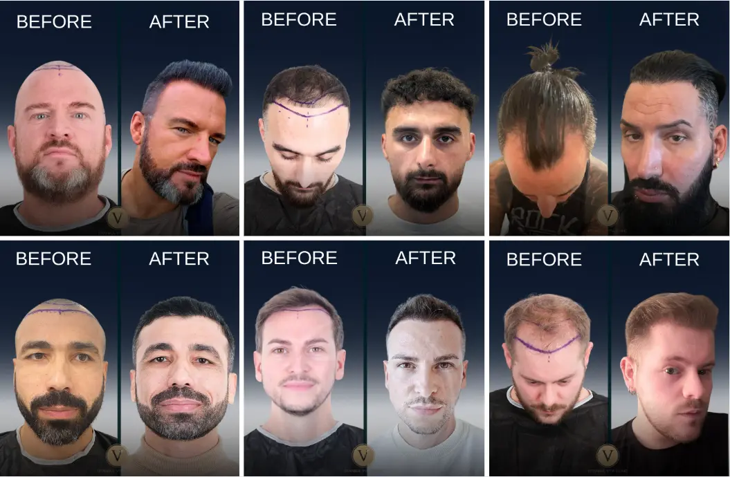 turkey hair transplant before after