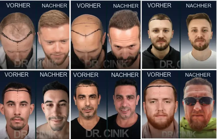 Dr. Cinik: Vorher-Nachher-Ergebnisse einer Haartransplantation