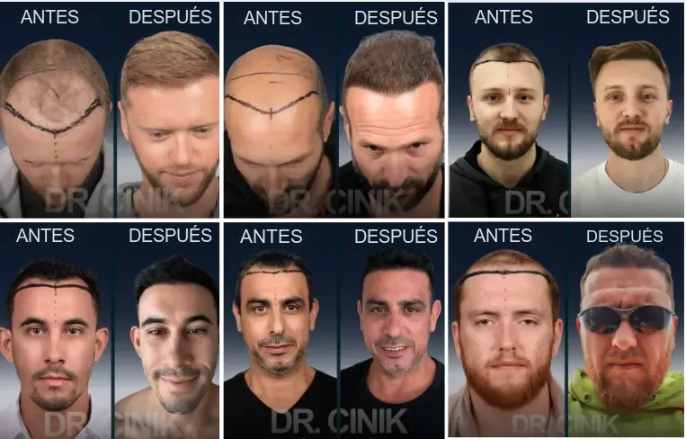 Dr. Cinik: resultados antes y después del trasplante capilar