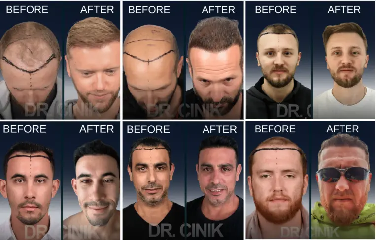 dr cinik before after results