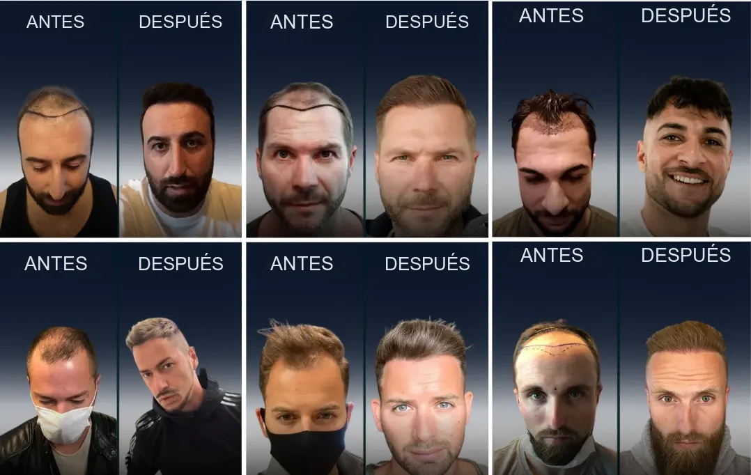 Elithair: resultados antes y después del trasplante capilar