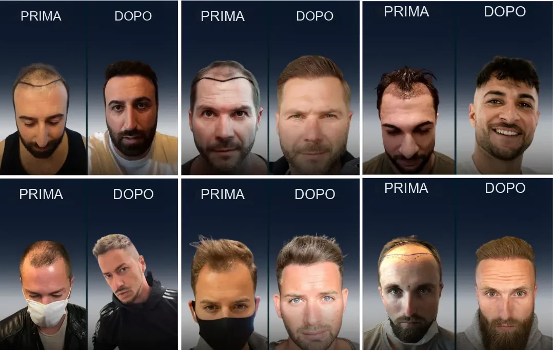 Elithair: risultati prima e dopo del trapianto di capelli