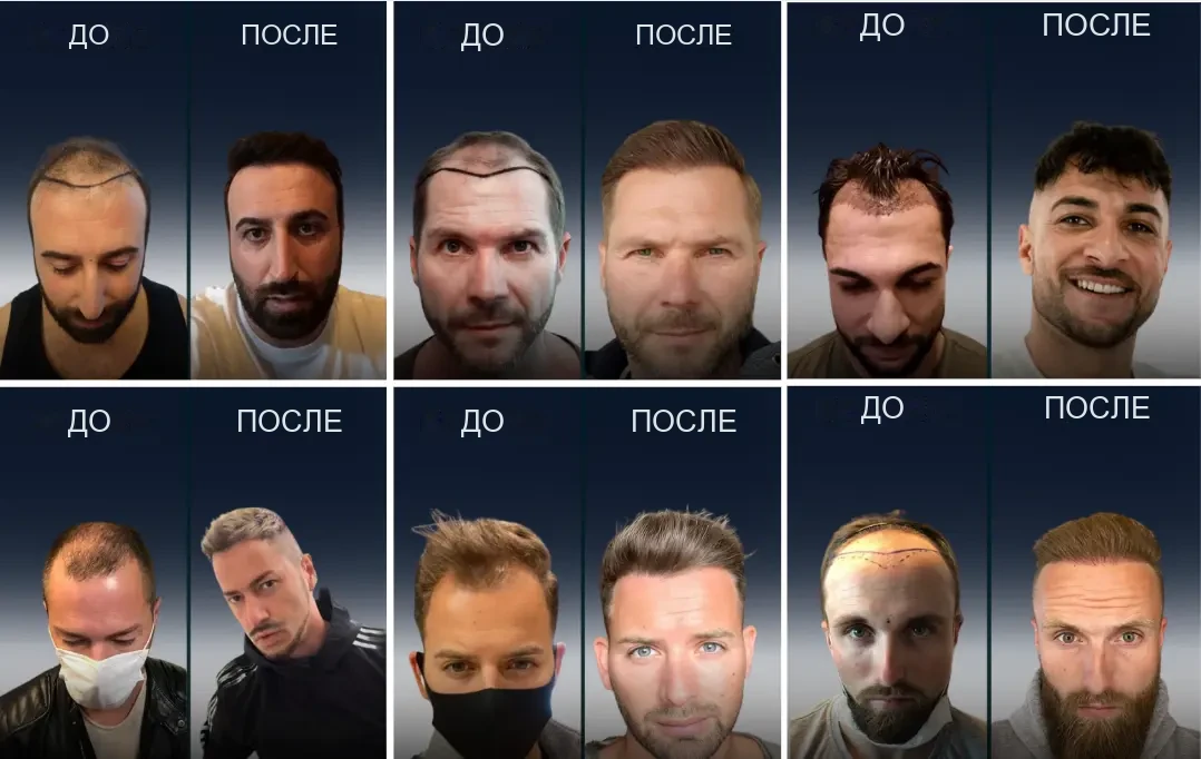 Elithair: результаты пересадки волос до и после