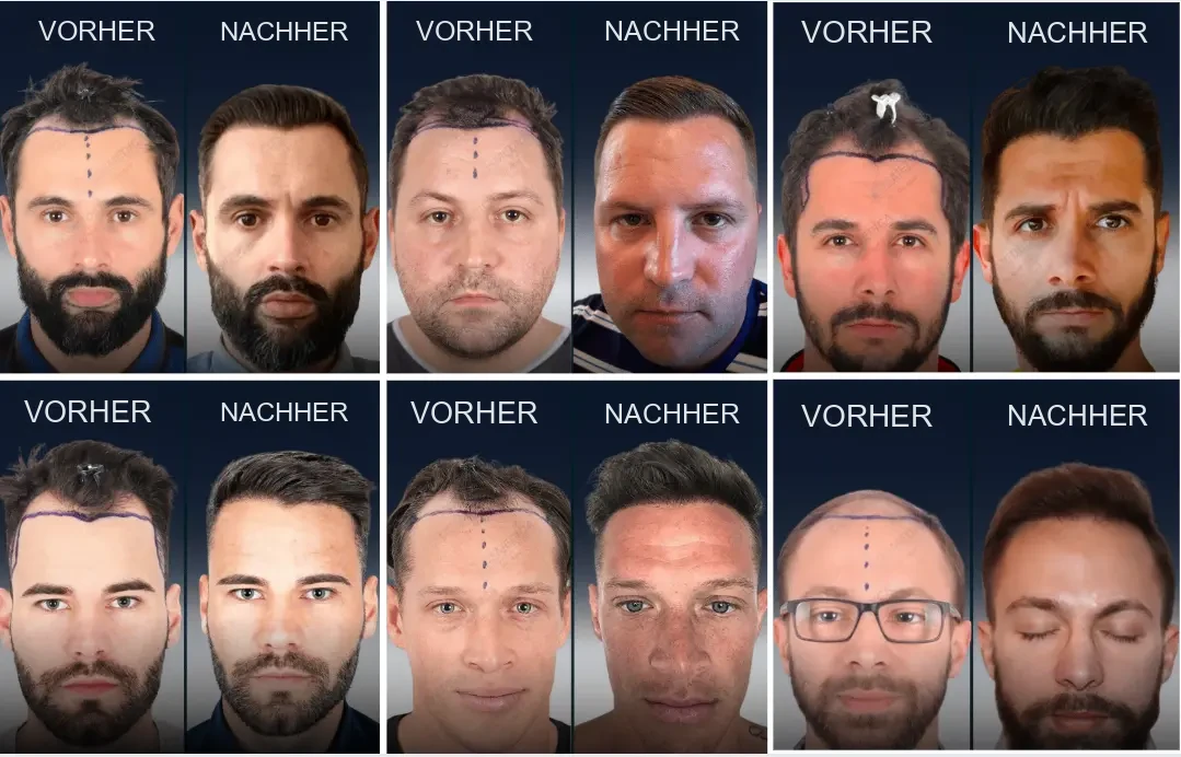 Cosmedica: Vorher-Nachher-Ergebnisse einer Haartransplantation