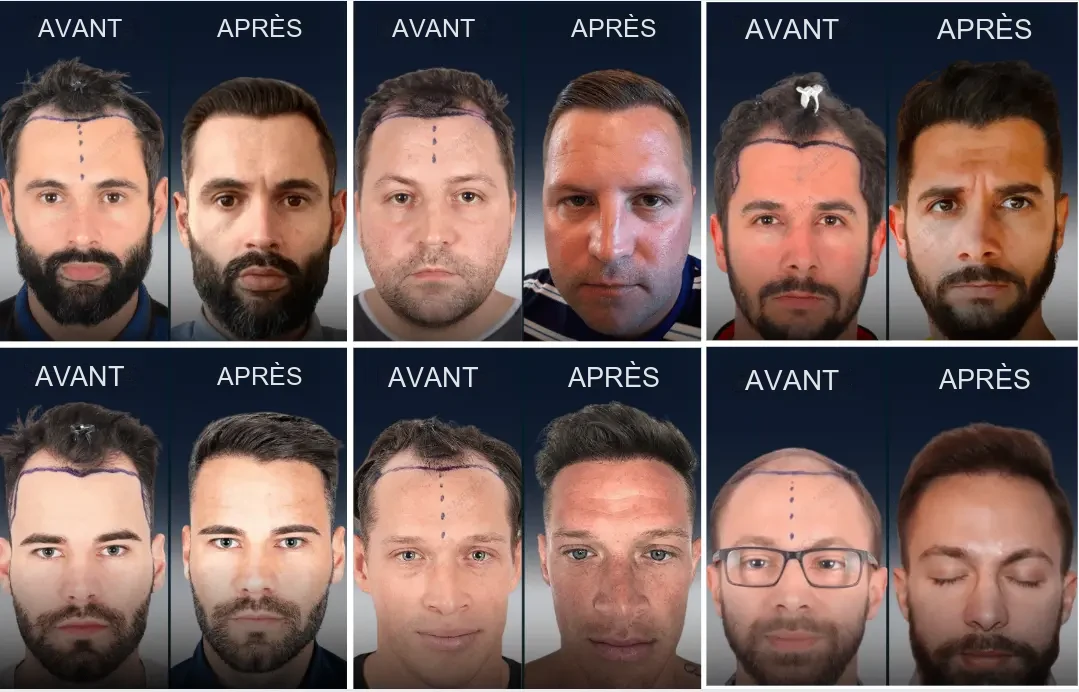 Cosmedica : résultats avant/après d'une greffe de cheveux