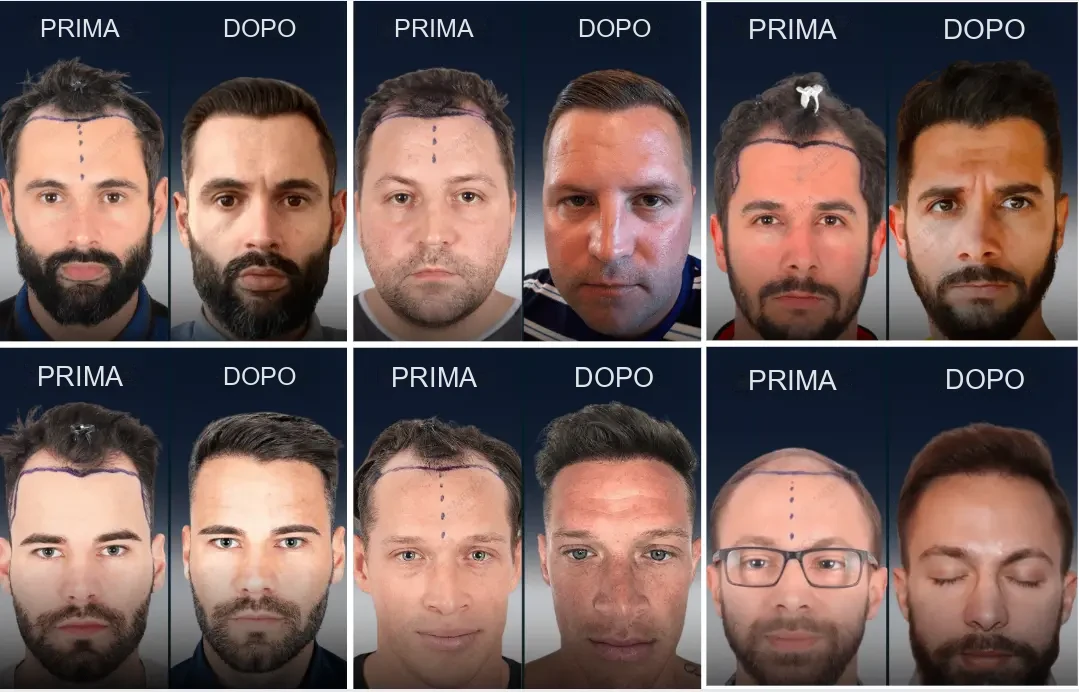 Cosmedica: risultati prima e dopo del trapianto di capelli