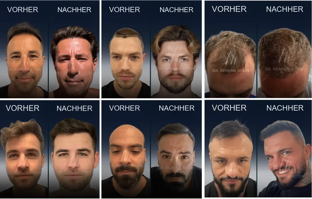 Dr. Serkan Aygın: Vorher-Nachher-Ergebnisse einer Haartransplantation