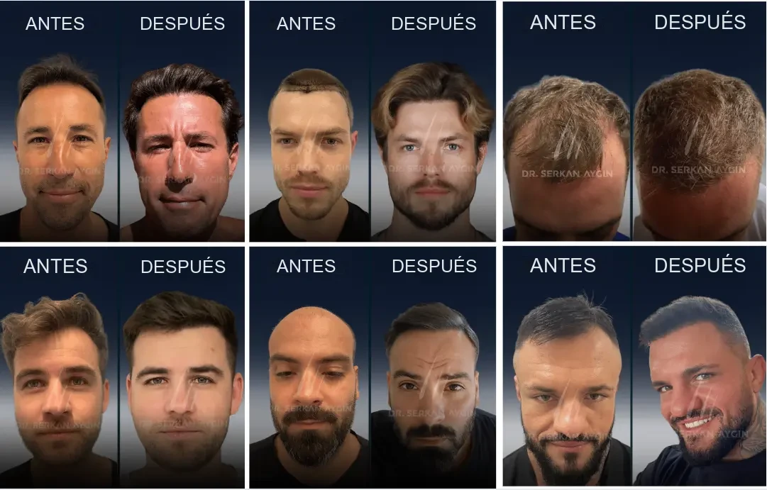 Dr. Serkan Aygın: resultados antes y después del trasplante capilar