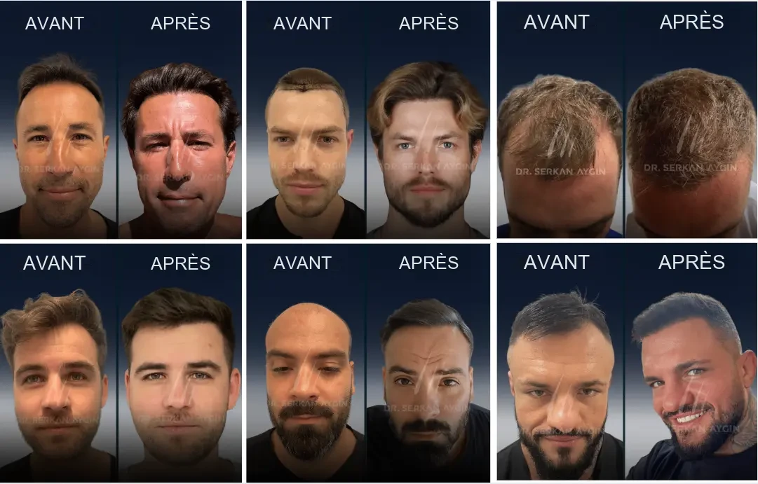 Dr. Serkan Aygın : résultats avant/après d'une greffe de cheveux