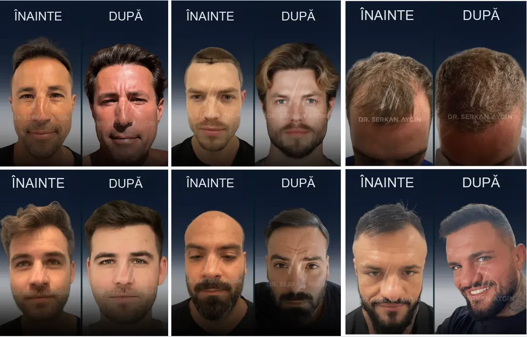 Dr. Serkan Aygın: rezultate înainte și după transplantul de păr