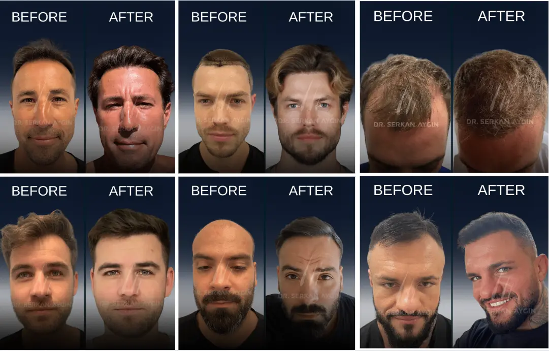 Dr serkan aygın before after results