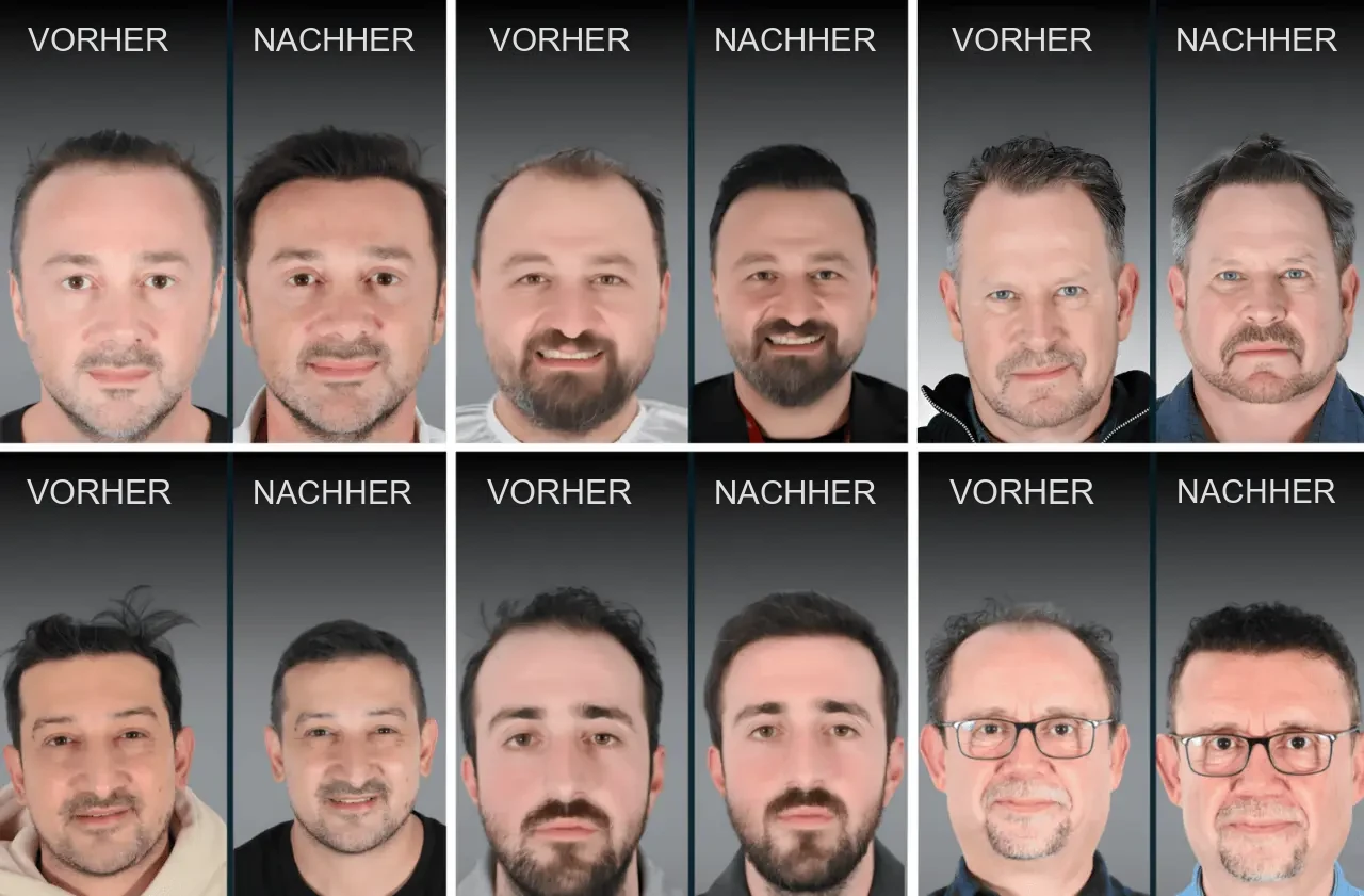 ASMED: Vorher-Nachher-Ergebnisse einer Haartransplantation