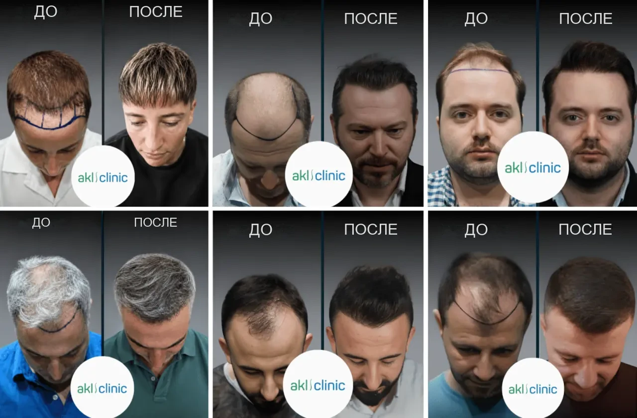 AKL Clinic: результаты пересадки волос до и после