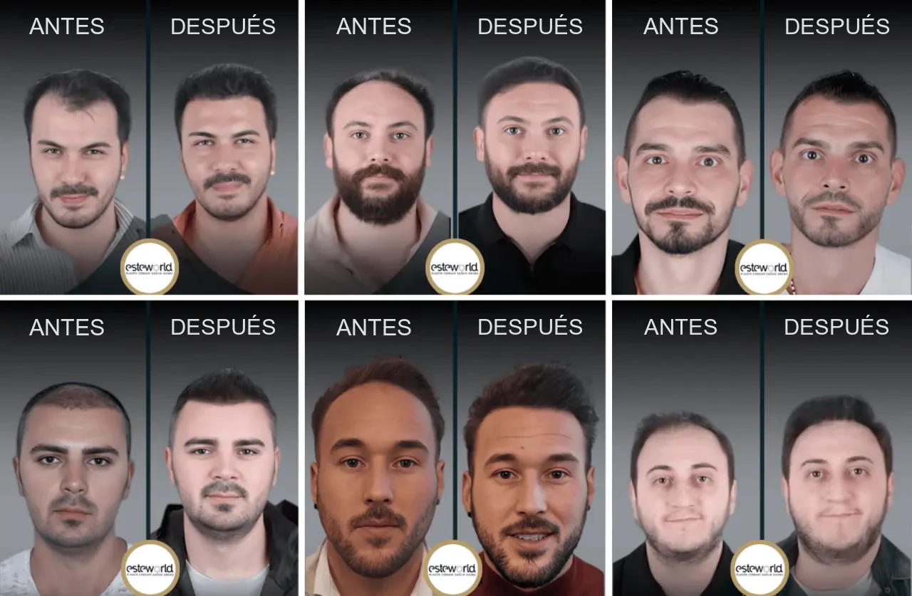 Esteworld: resultados antes y después del trasplante capilar