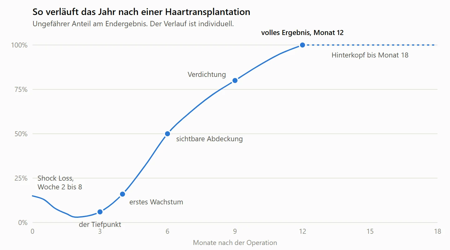 Wachstumskurve nach einer Haartransplantation: Einbruch durch Shock Loss in Woche 2 bis 8, Tiefpunkt um Monat 3, erstes Wachstum in Monat 4, sichtbare Abdeckung in Monat 6 und volles Ergebnis in Monat 12, am Hinterkopf bis Monat 18.