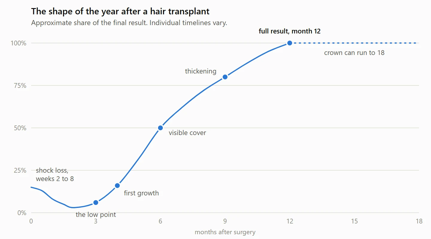 Growth curve after a hair transplant: a dip during shock loss in weeks 2 to 8, the low point around month 3, first growth at month 4, visible cover at month 6 and the full result at month 12, with the crown continuing to month 18.