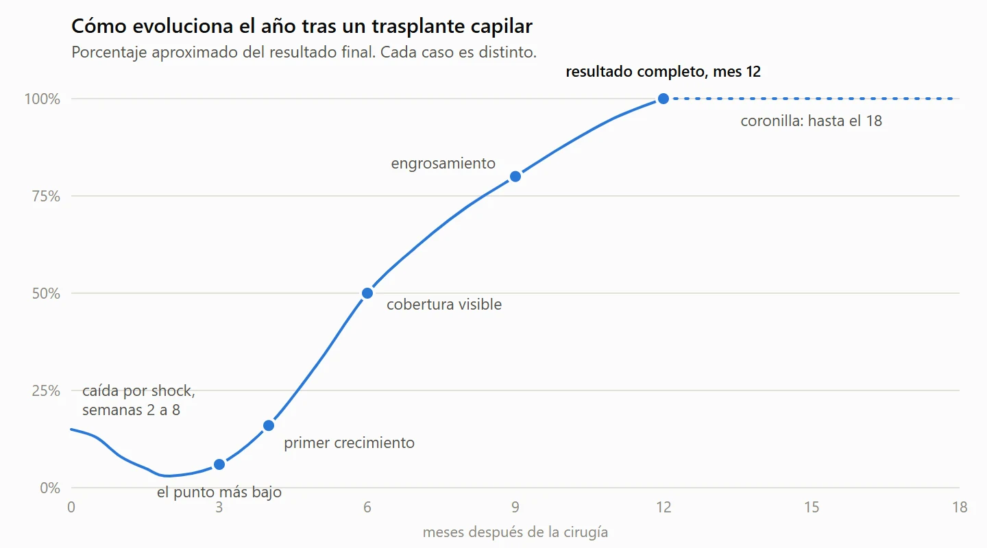 Curva de crecimiento tras un trasplante capilar: descenso por la caída por shock en las semanas 2 a 8, punto más bajo hacia el mes 3, primer crecimiento en el mes 4, cobertura visible en el mes 6 y resultado completo en el mes 12; la coronilla puede seguir hasta el mes 18.