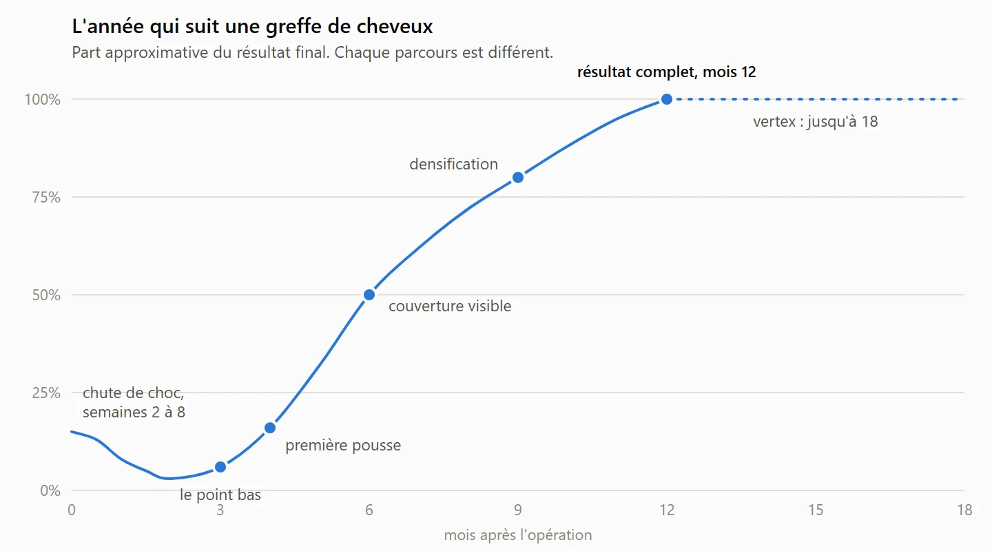 Courbe de pousse après une greffe de cheveux : creux de la chute de choc entre les semaines 2 et 8, point bas vers le mois 3, première pousse au mois 4, couverture visible au mois 6 et résultat complet au mois 12, le vertex pouvant aller jusqu'au mois 18.