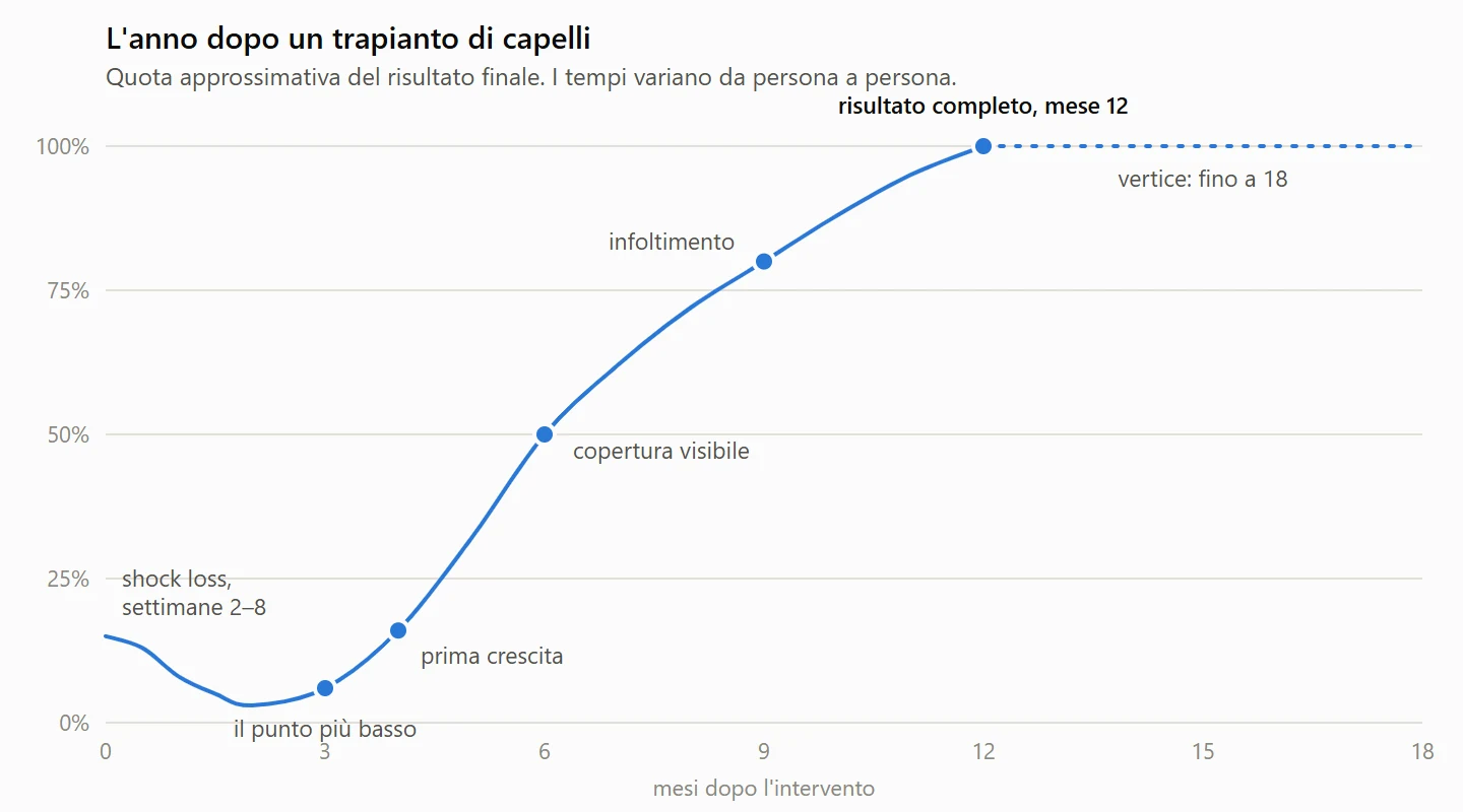 Curva di crescita dopo un trapianto di capelli: calo dovuto allo shock loss nelle settimane 2–8, punto più basso intorno al mese 3, prima crescita al mese 4, copertura visibile al mese 6 e risultato completo al mese 12, con il vertice fino al mese 18.