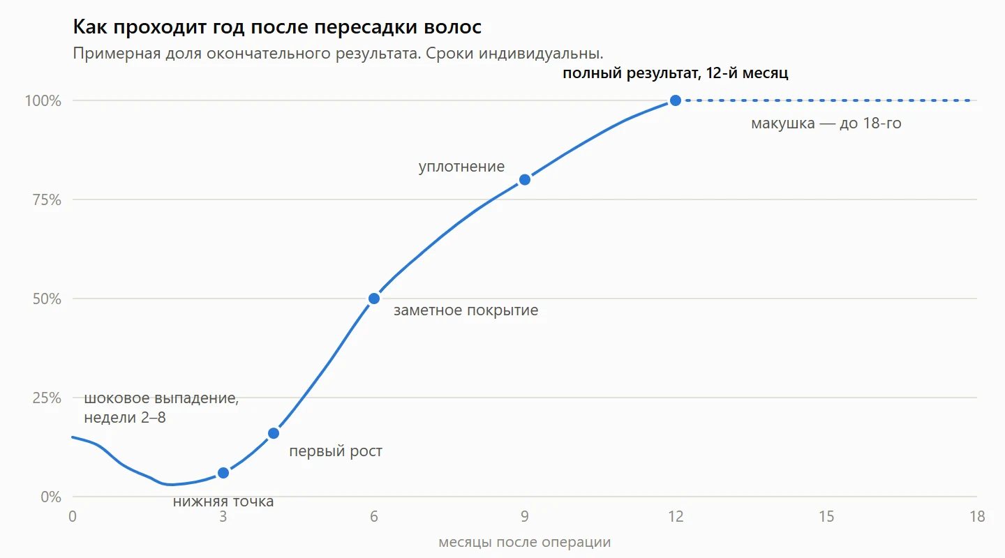 Кривая роста после пересадки волос: спад из-за шокового выпадения на 2–8-й неделях, нижняя точка около 3-го месяца, первый рост на 4-м месяце, заметное покрытие на 6-м и полный результат на 12-м месяце; макушка — до 18-го месяца.