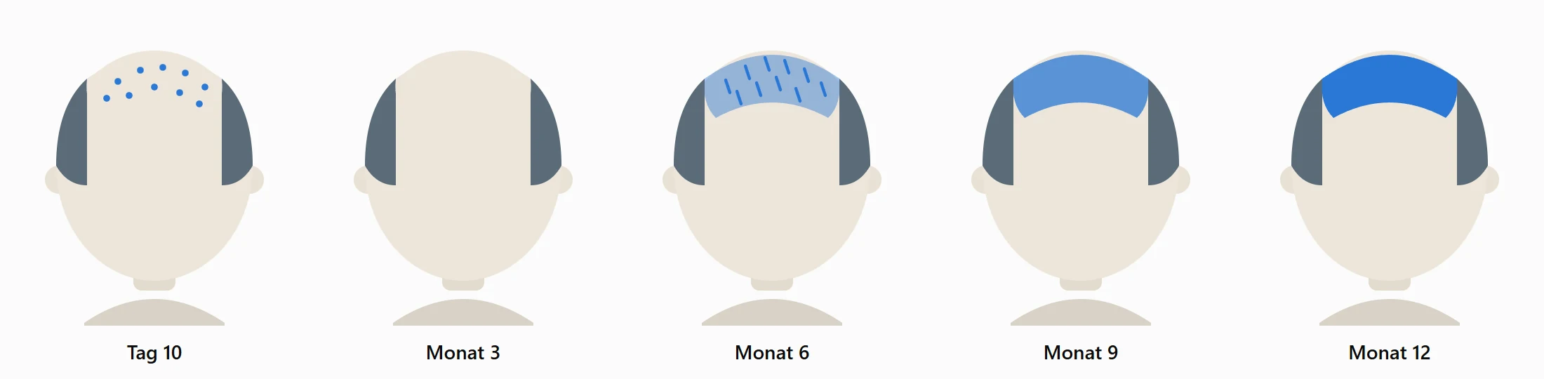 Illustration des transplantierten Bereichs an Tag 10 sowie in Monat 3, 6, 9 und 12 nach einer Haartransplantation