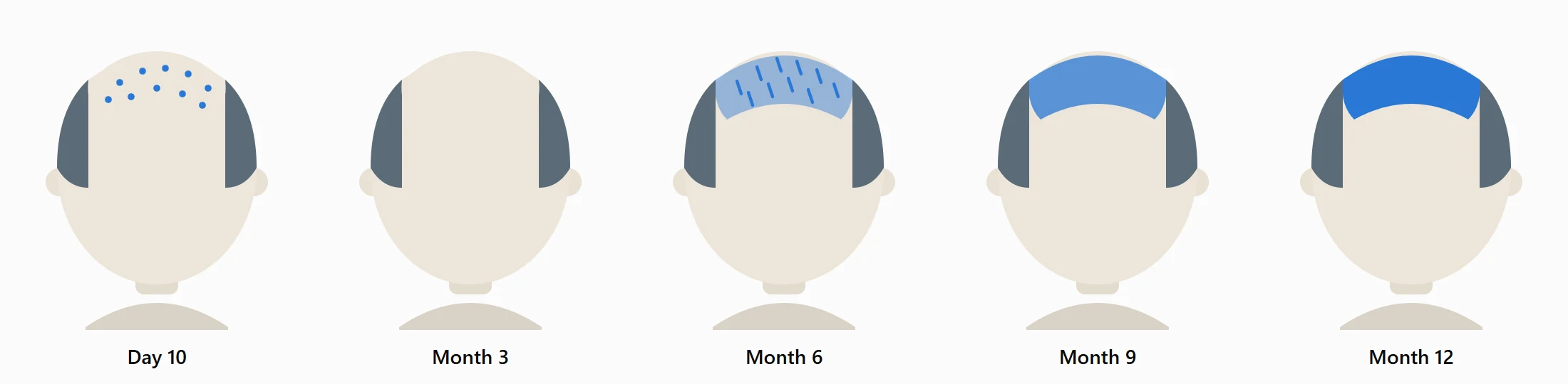 Illustration of the transplanted area on day 10 and at months 3, 6, 9 and 12 after a hair transplant