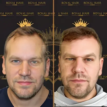Royal Hair Istanbul