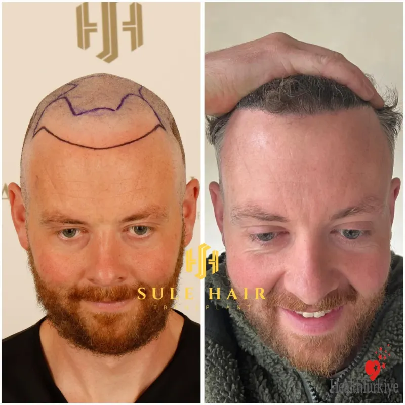 Sule Hair Clinic